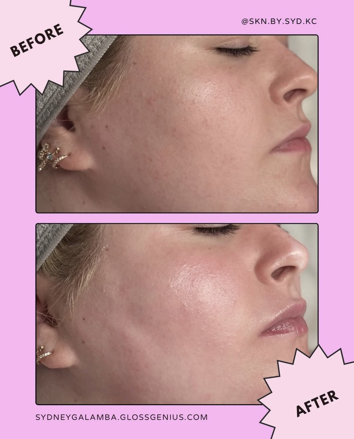 Side profile of a woman's face before and after skincare treatment, showing smoother skin in the after image.
