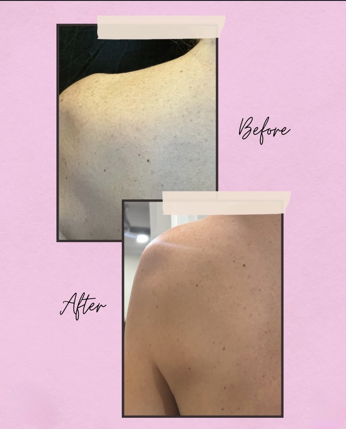 Comparison of skin before and after treatment showing reduced freckles and clearer skin.