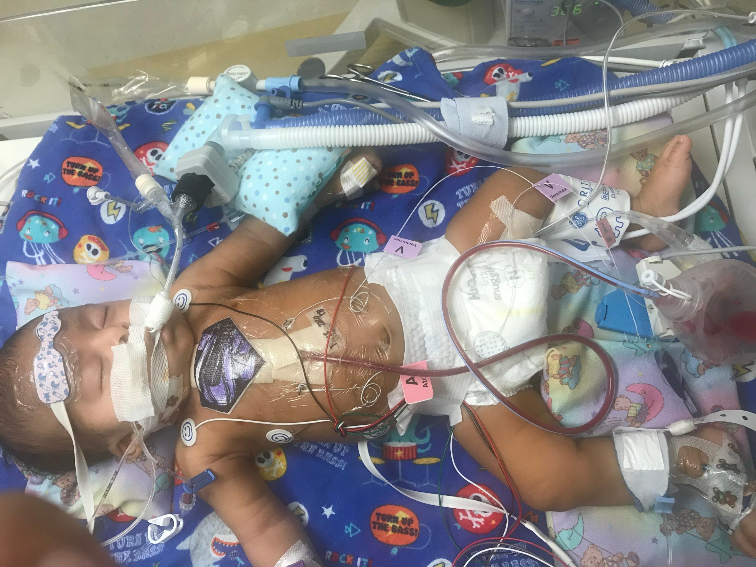 Baby in hospital bed connected to medical devices, with tubes and wires, wearing a diaper, in a neonatal intensive care unit.