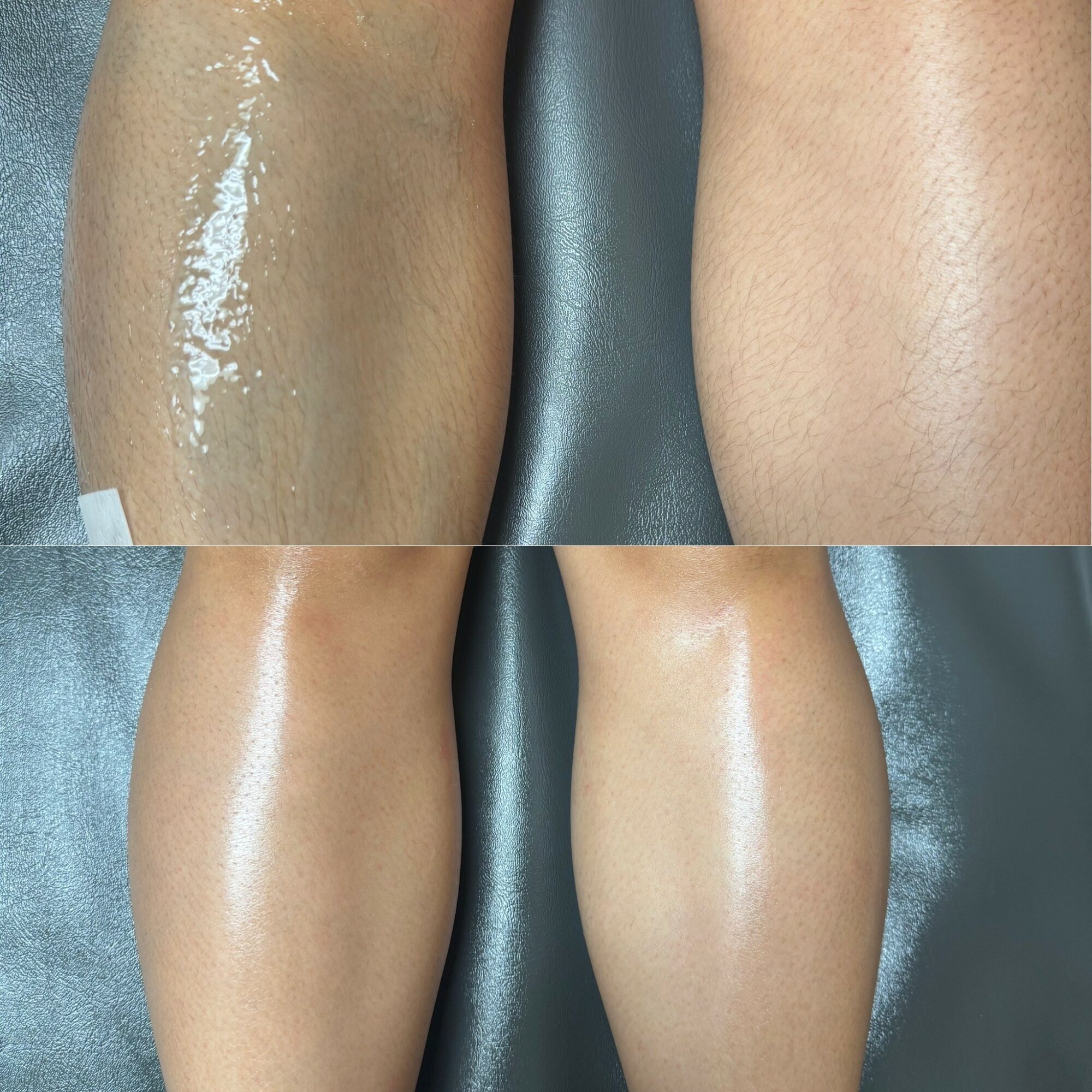 Comparison of two legs showing skin before and after treatment, with smoother, clearer skin in the after images.