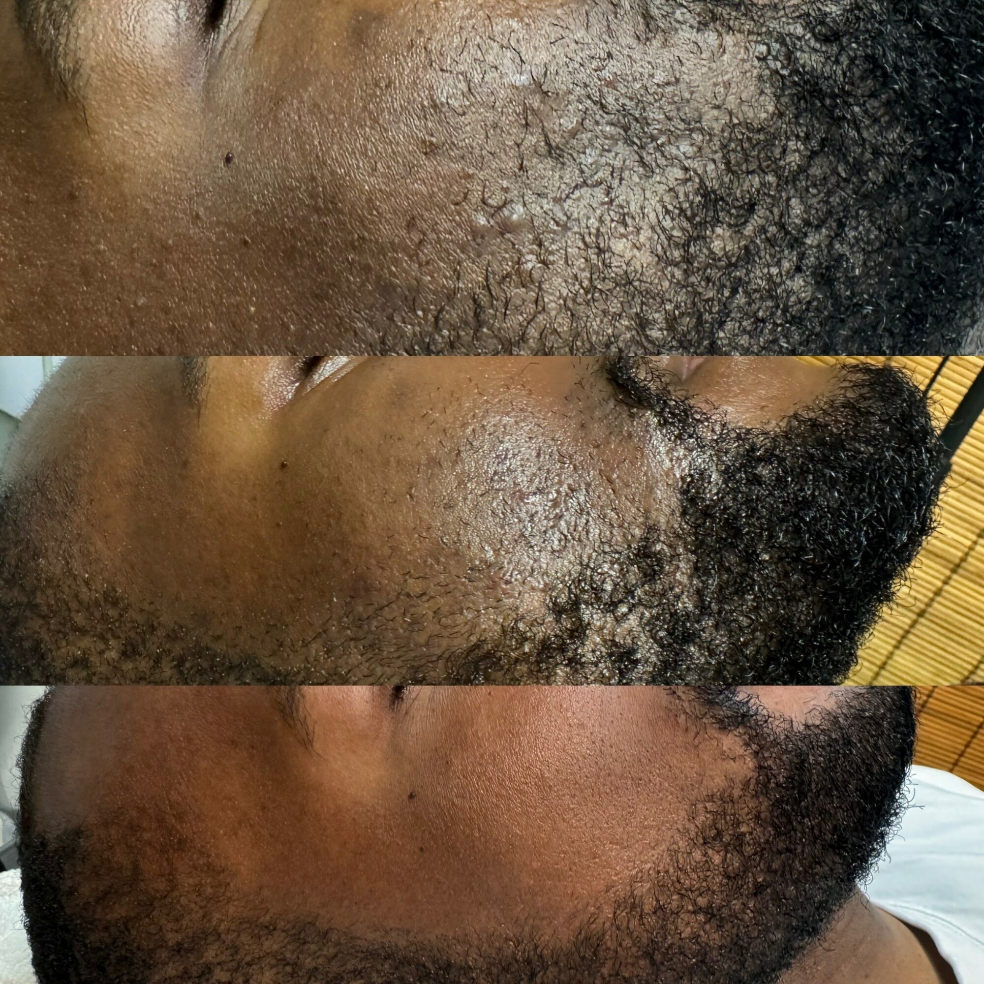 Close-up of a person's face showing skin and facial hair, with visible texture and hair growth.