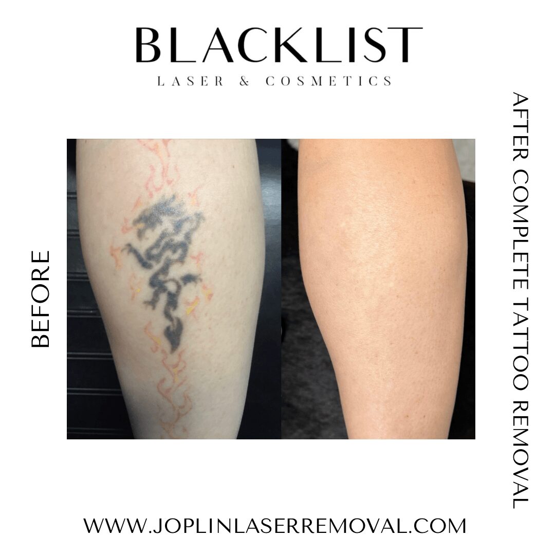 Side-by-side comparison of a tattoo before and after removal, showing clear skin post-treatment.
