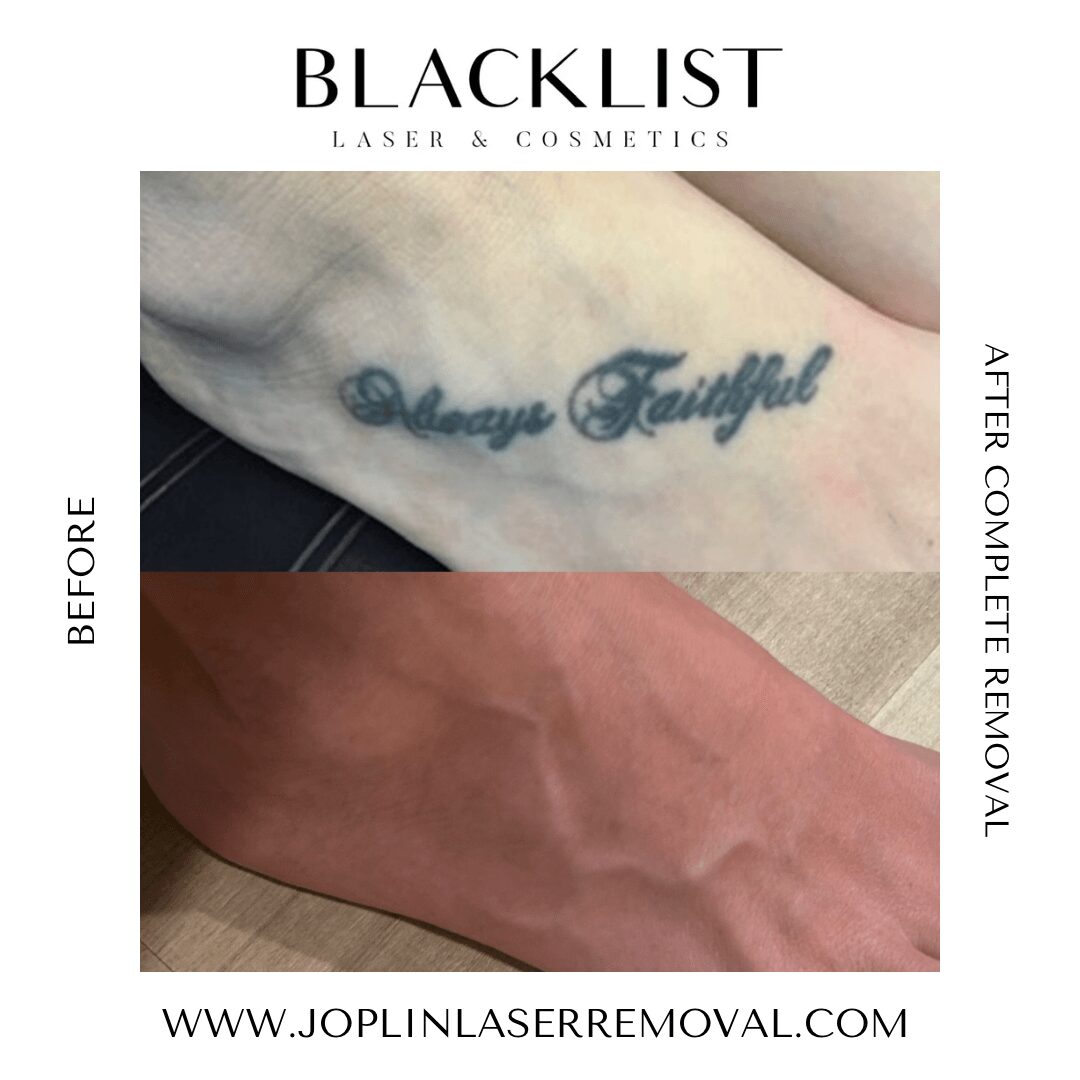 Tattoo removal process showing tattoo partially erased on skin, with text 'Always Faithful' before and after removal.