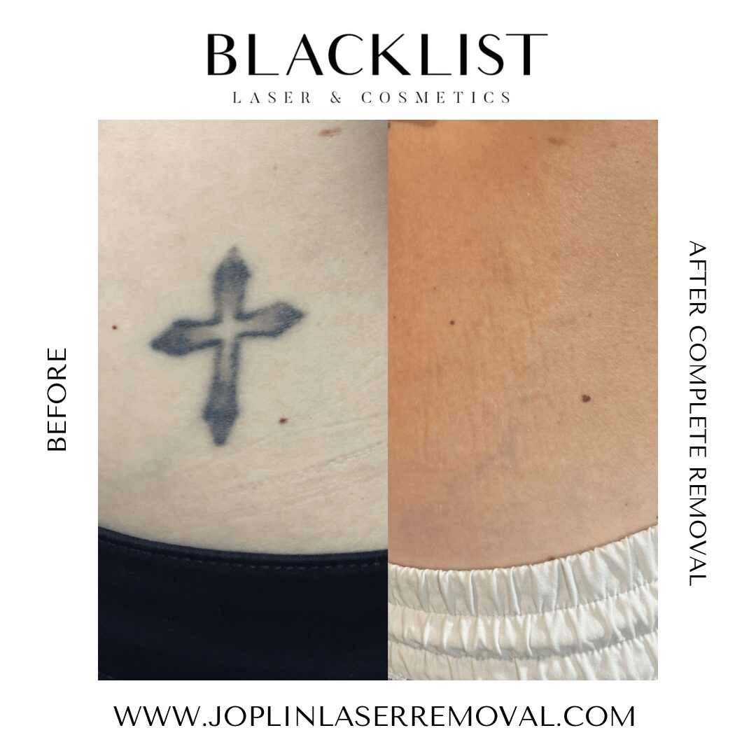 Comparison of skin with tattoo before and after laser removal, showing significant fading. Text promotes laser and cosmetic services.