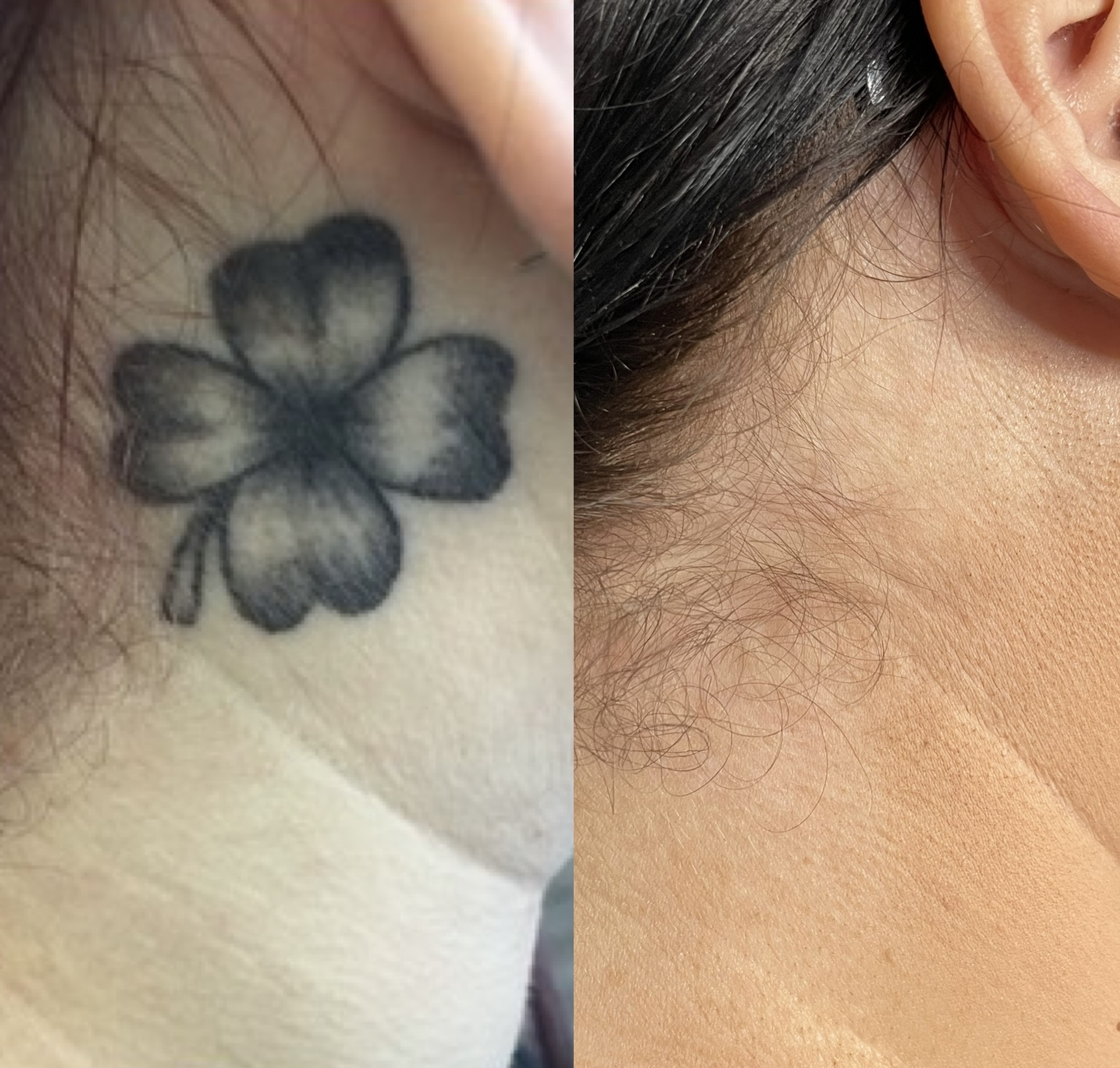 Close-up of a person's neck with a small, faded tattoo of a four-leaf clover, and the skin appears smooth.