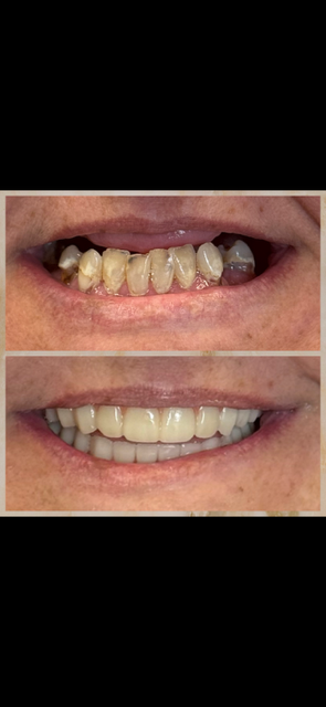 Comparison of teeth before and after dental treatment, showing improved alignment and cleanliness.