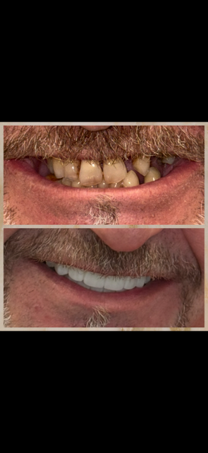 Comparison of teeth before and after dental treatment, showing improved appearance and alignment.