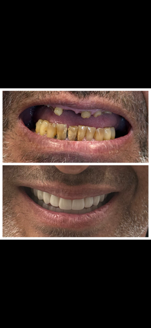 Two images showing a person's teeth before and after dental treatment, with the second image displaying improved, cleaner teeth.
