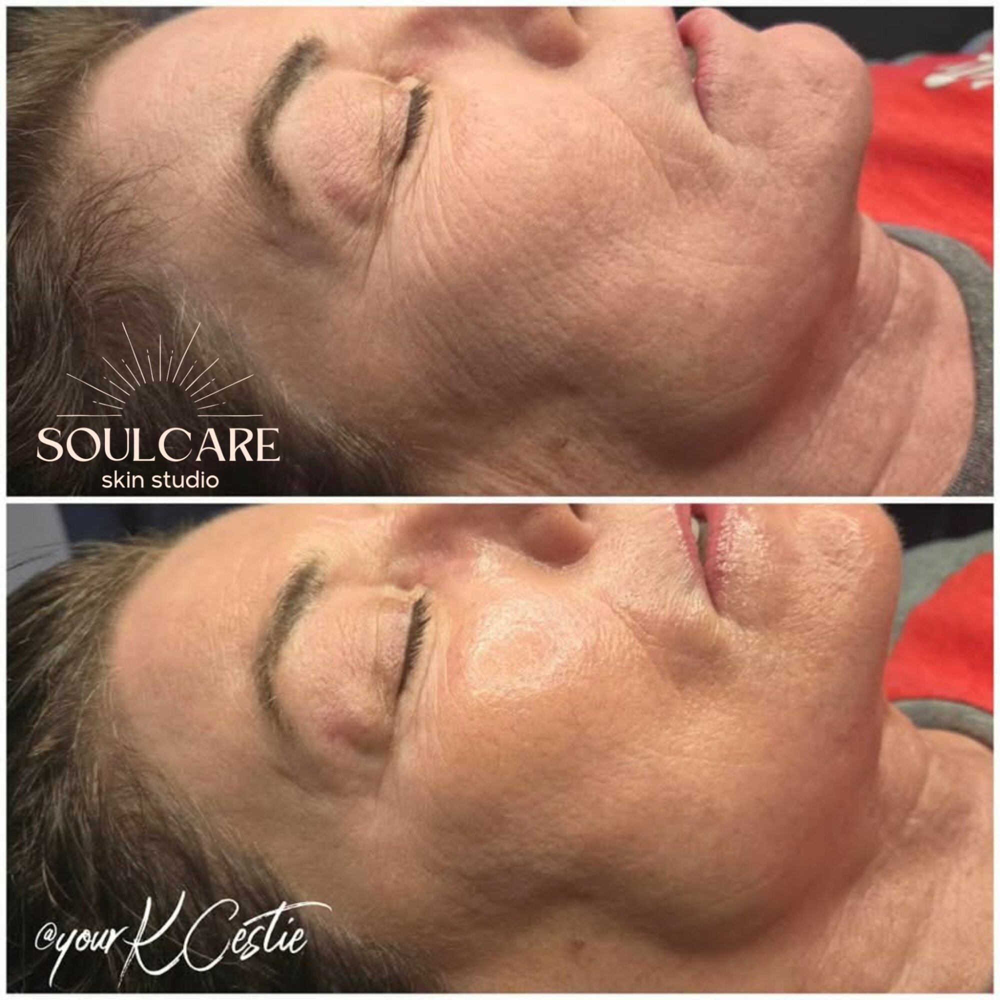 Before and after facial skin treatment showing improved skin texture and reduced wrinkles.