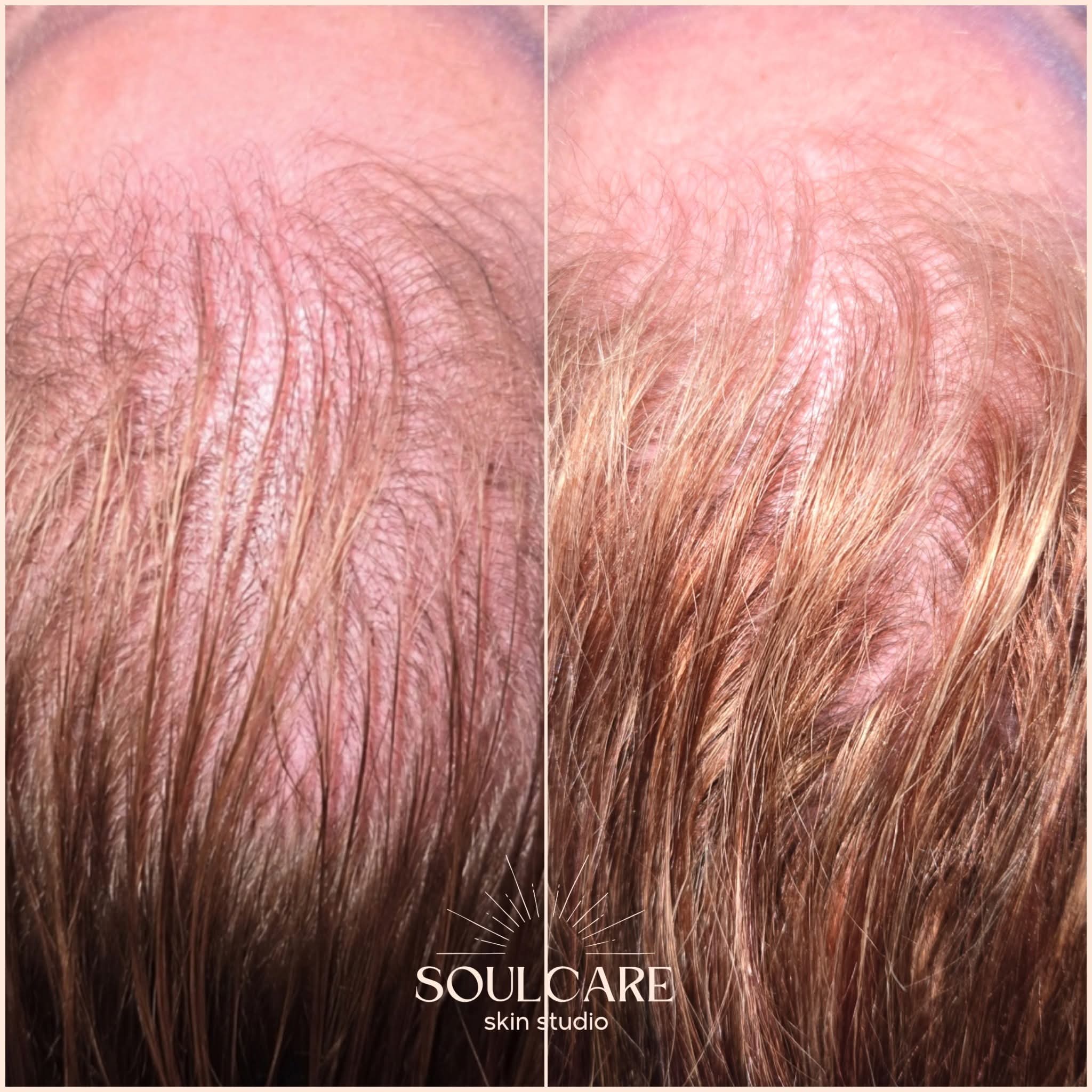 Comparison of forehead skin showing reduced wrinkles after treatment, with visible improvement in skin texture and appearance.