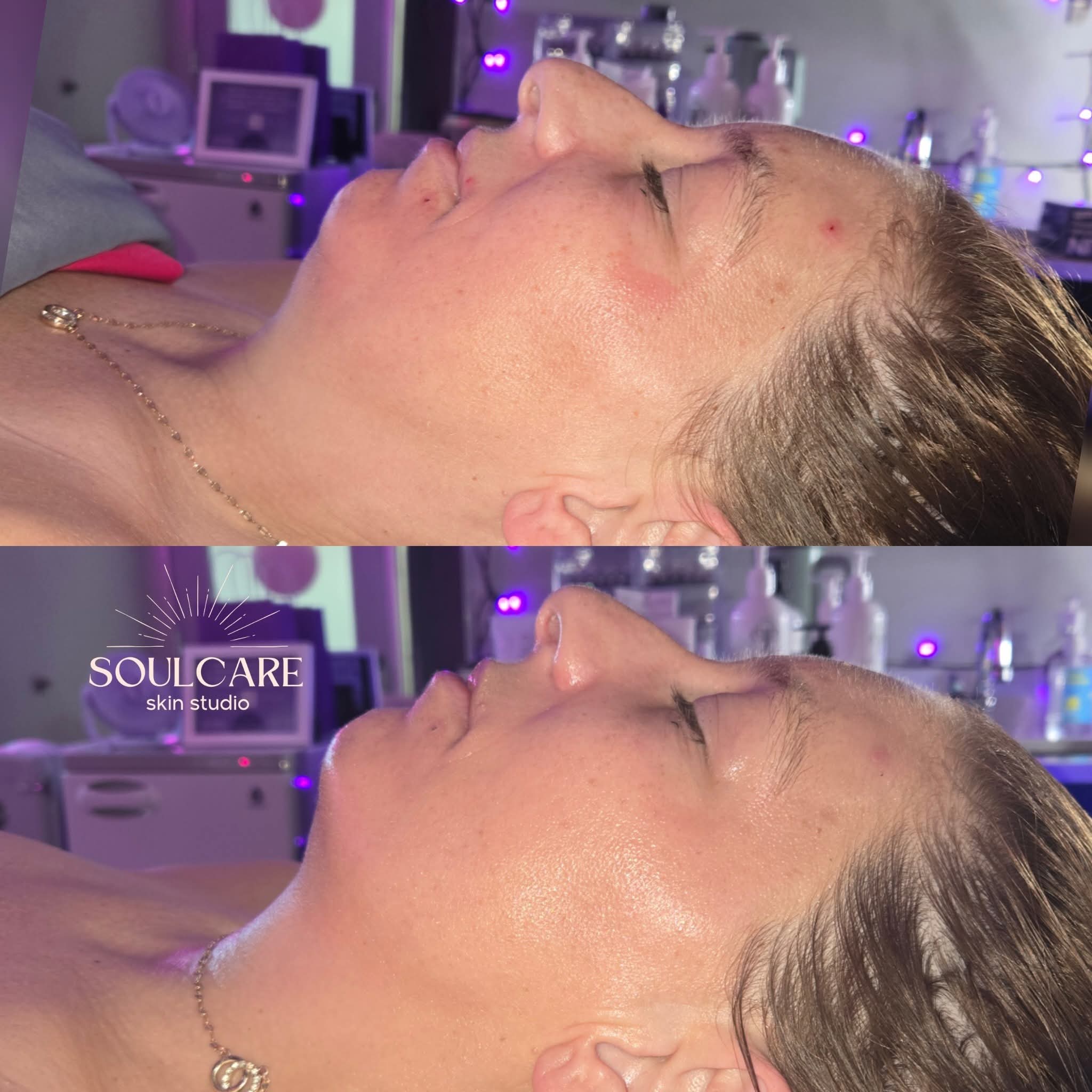Side view of a woman with clear skin, lying down in a skincare studio, before and after treatment, with purple lighting.