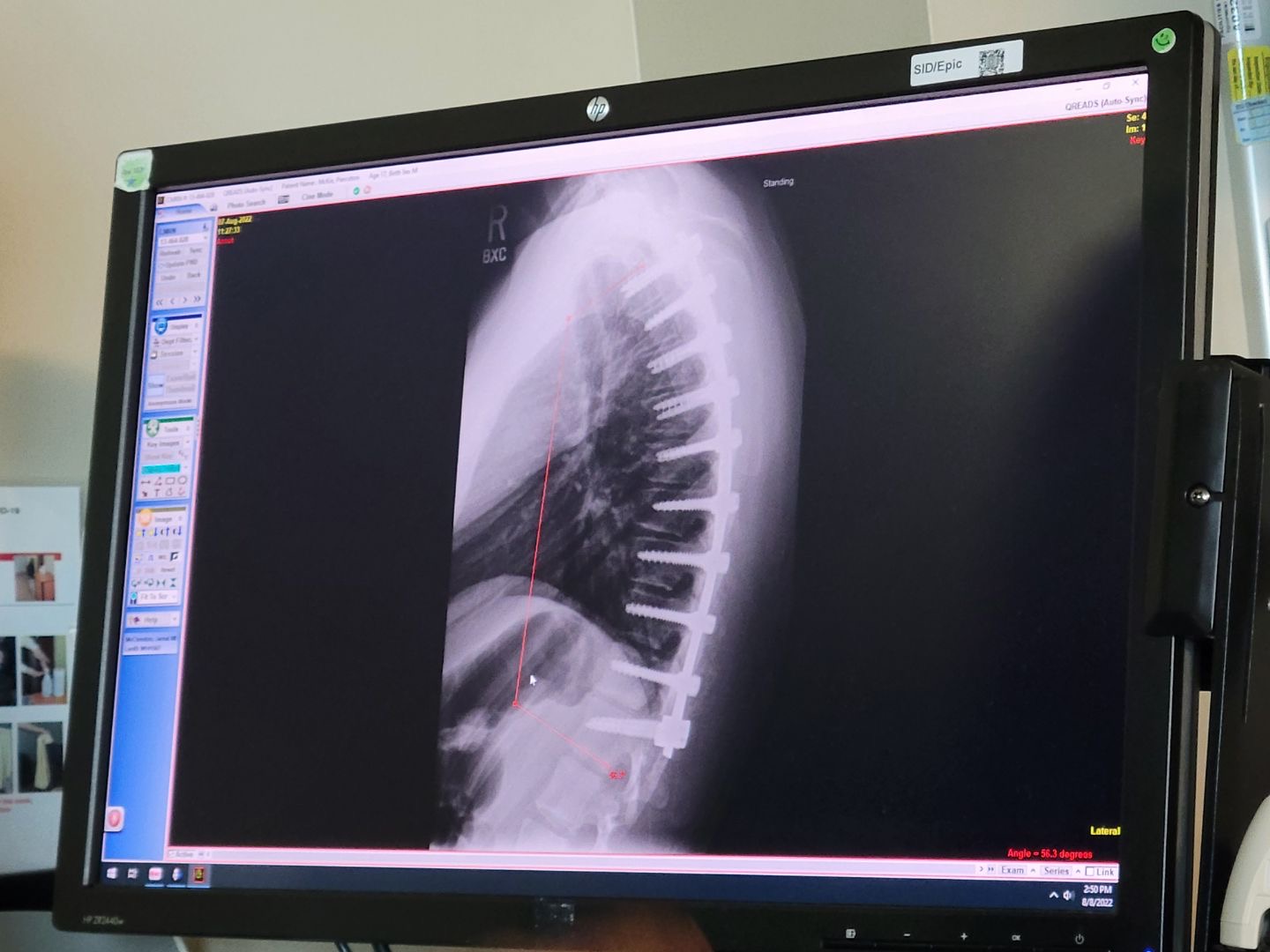 X-ray of a person's spine and ribcage in a vertical position, displayed on a computer monitor.